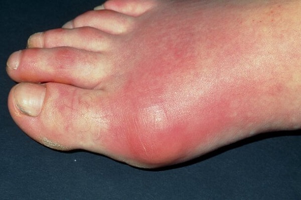Hình ảnh khớp viêm sưng nóng đỏ đau trong bệnh gút