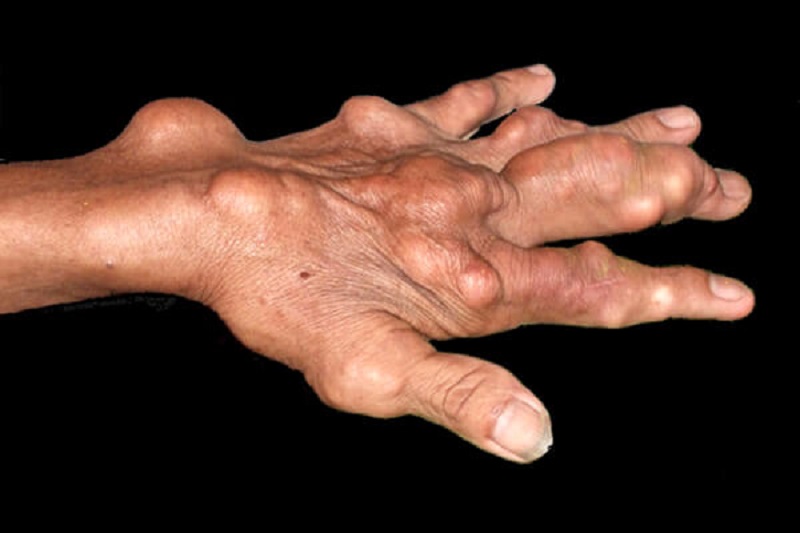 Bệnh gút có nguy hiểm không - Các khớp tay bị biến dạng vì bệnh gút