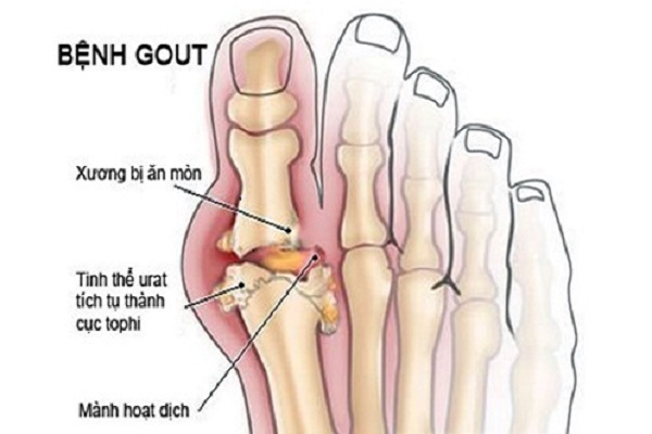 Bệnh gút(gout) là gì? tăng acid uric máu có phải bệnh gút?