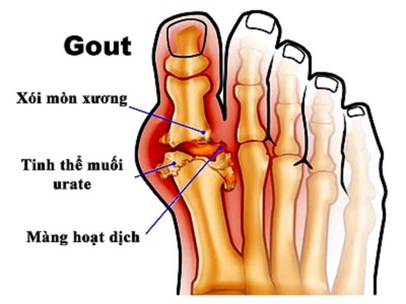 Bệnh gút (gout) là gì?