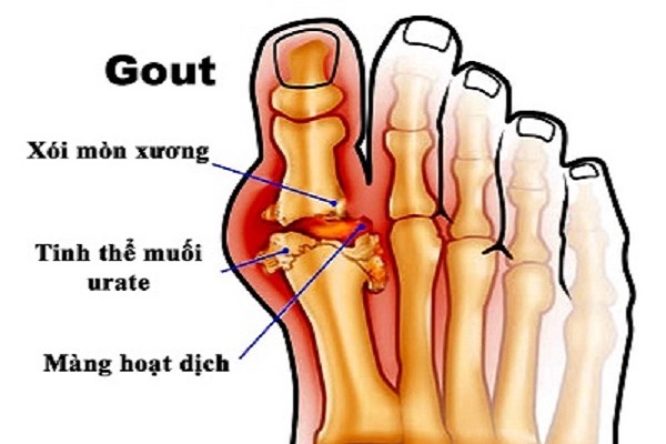 Bệnh gút(gout) là gì? căn nguyên gây bệnh gút(gout)