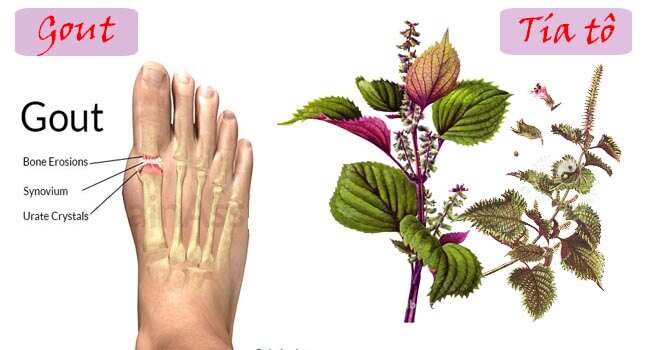 Tí tô hỗ trợ điều trị gút (gout) rất hiệu quả